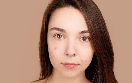 Teljes arcos akné és pattanásos bőr kezelés photorejuvenációval, intenzív SHR E-Light technológiával, fájdalommentesen! Plusz 30% kedvezmény gyulladáscsökkentő mezoterápiára! kupon