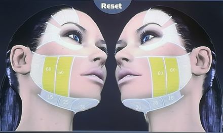 Professzionális HIFU - mikrofókuszált ultrahang ránctalanító és arcfiatalító kezelés teljes arcon! Plusz 50% kedvezmény sejtaktiváló Medical lézer kezelésre! kupon