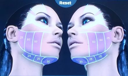 Professzionális HIFU  arcfiatalító és ránctalanító kezelés teljes arcon, tokán és nyakon! Plusz 40% kedvezmény növényi őssejtes MezoILaser arckezelésre! kupon