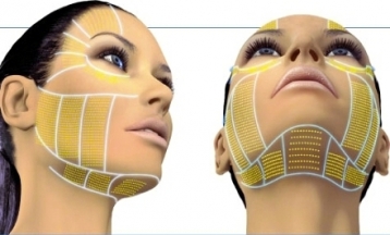 Gyémántfejes mikrodermabráziós arc és nyak hámlasztás rádiófrekvenciás vákuumos bőrfeszesítéssel, és infravörös fényenergiával! - akciós kupon