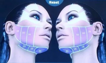 Professzionális HIFU  arcfiatalító és ránctalanító kezelés teljes arcon, tokán és nyakon! Plusz 40% kedvezmény növényi őssejtes MezoILaser arckezelésre! - akciós kupon