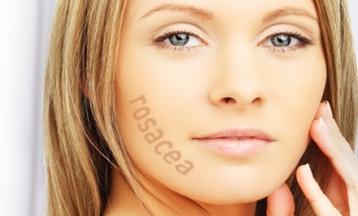 Nd Yag lézeres Rosacea vagy hajszálér eltűntető kezelés teljes arcon! - akciós kupon